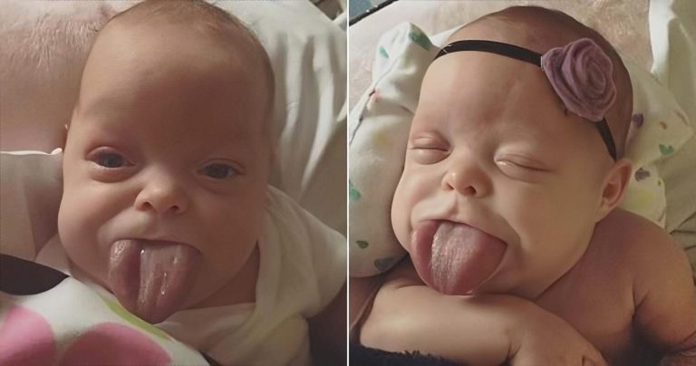 It's heartbreaking to see a baby born with an unusually large tongue, hope all the best will come to him in the future.