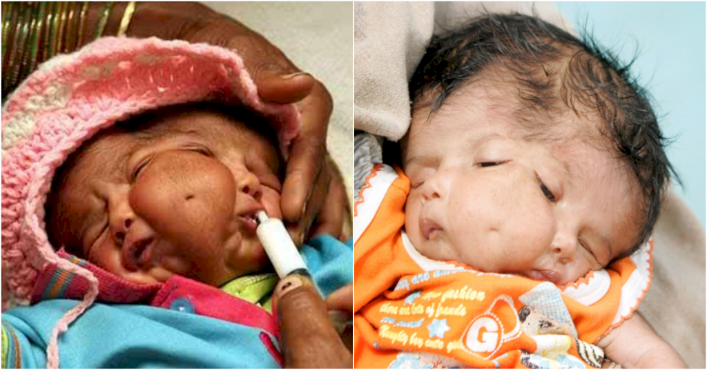 A baby with a normal body but two faces is born, which is quite unusual_babies