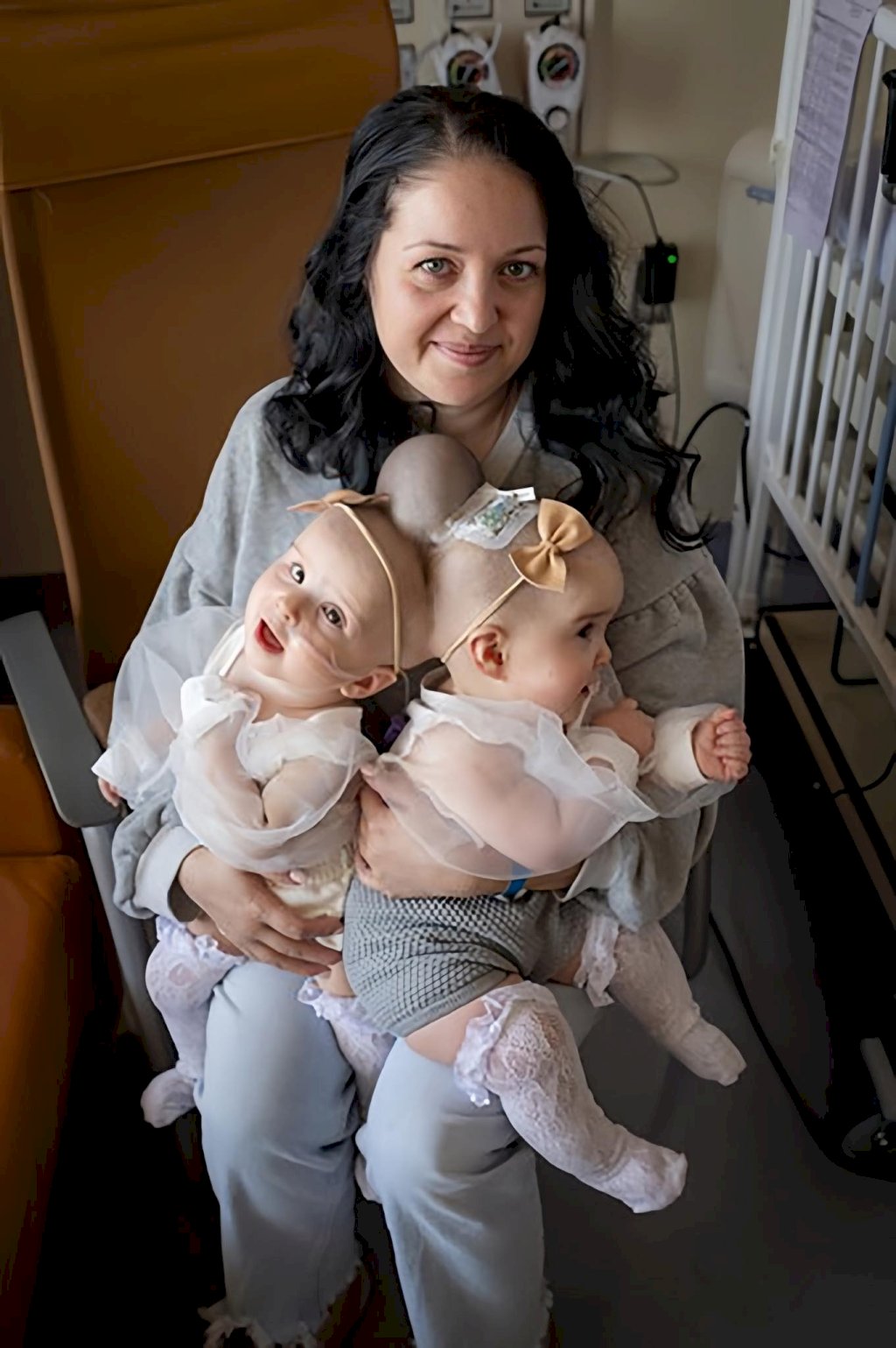 boundless hope: separating conjoined twins successfully. congrats baby