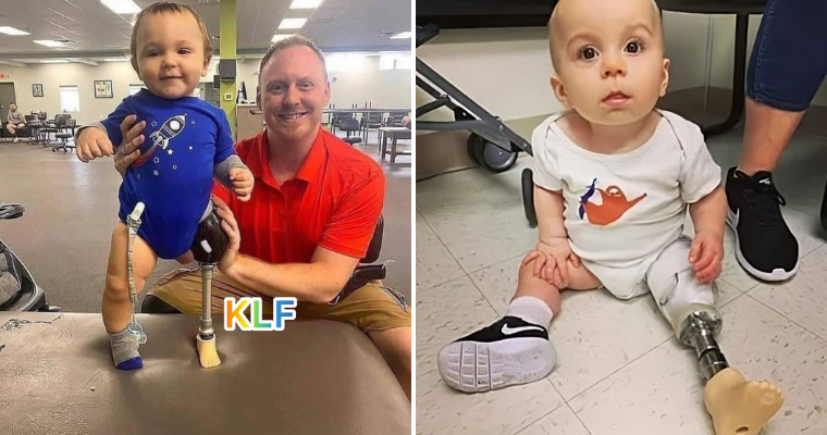 Father’s DIY Miracle: Crafting Homemade Prosthetic Legs for His Baby’s First Steps