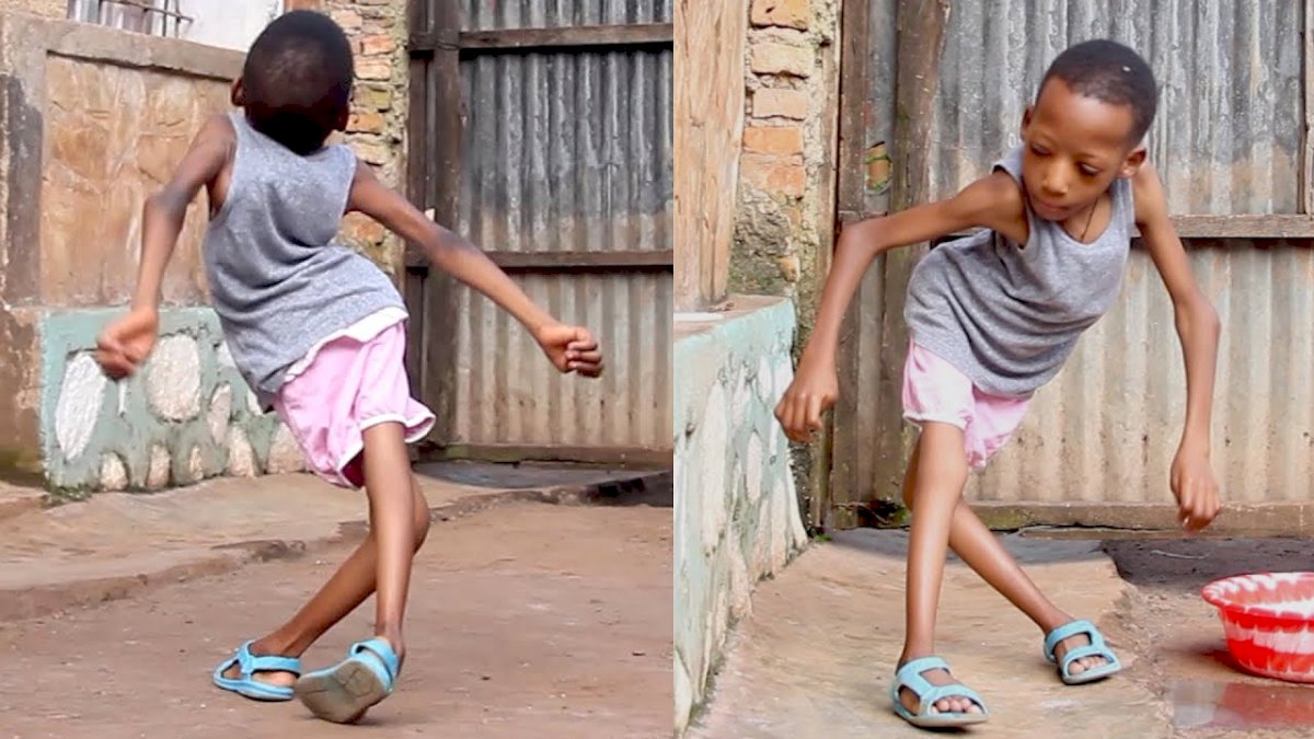 Against All Odds, The Incredible Tale of the Girl Embracing Life with Scissor Legs